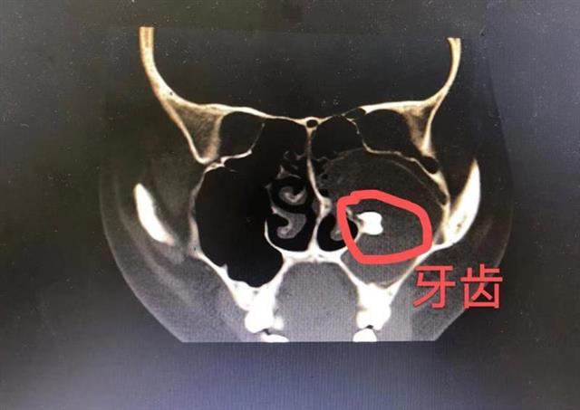 这颗从上颌骨长入鼻腔里的牙齿,在医学上叫做异位牙.