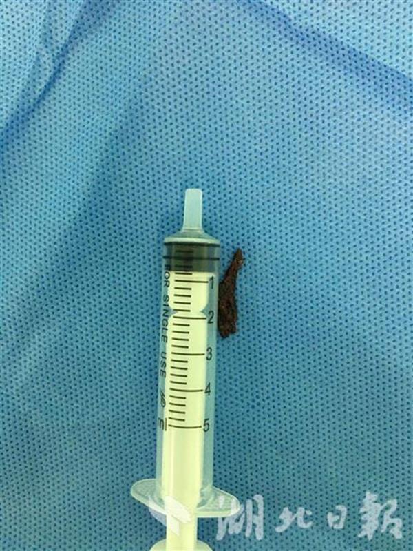 |大意！鱼骨“入”肺10年遗憾！男子切除部分左肺
