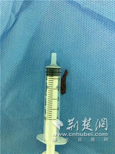 |鱼骨藏肺10年致肺空洞坏死男子切除部分左肺