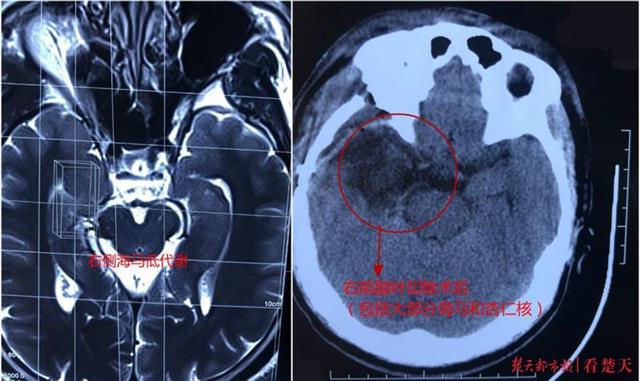 |男子十年来频频“被伤害”，竟是顽固性癫痫惹祸