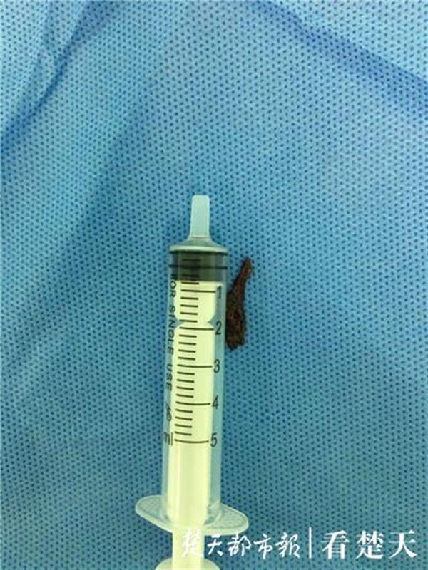 |鱼骨“藏”肺十载，中年男左下肺叶空洞坏死