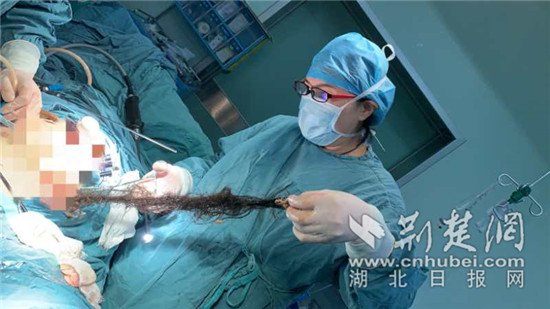 |畸胎瘤“潜伏”女子腹中 医生取出2米多长头发