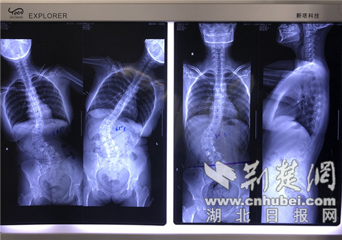 BALLBET贝博体育|洛克王国刷绝版宠物挂|家长注意：别让脊柱侧弯毁了孩子