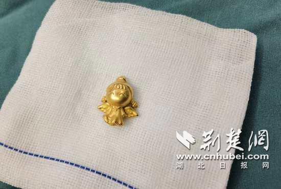 |现实版“吞金兽”！一不留神9个月大婴儿吞下金吊坠
