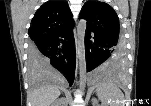 |11岁男孩感染肺吸虫，两片肺长成桃心形！都是因为这个坏习惯
