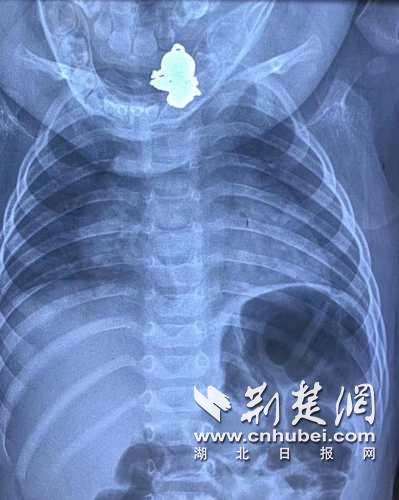 |现实版“吞金兽”！一不留神9个月大婴儿吞下金吊坠