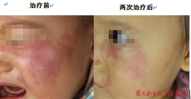 |女婴左脸大片“天使之吻”，来汉求医两次治疗消除