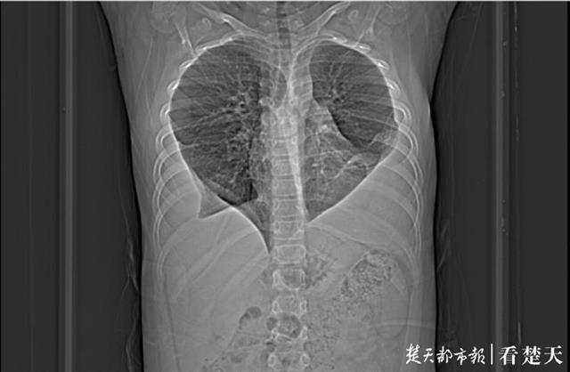 |11岁男孩感染肺吸虫，两片肺长成桃心形！都是因为这个坏习惯