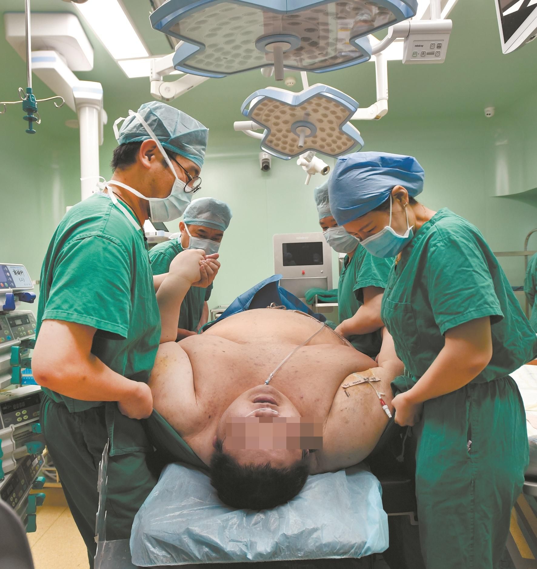 |“江城第一胖”手术切掉大半个胃 预计一年内体重可减掉100公斤