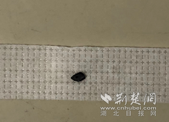 |男子打木柜被铁屑崩穿眼珠 医生眼内巧捉“真凶”保视力