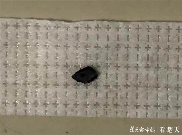 |米粒大铁屑正中老木匠的眼球，医生眼内巧捉“真凶”保住其视力