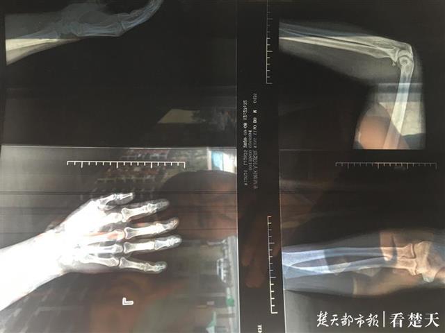 |装修工从两米高铁架子上飞出，左手多处骨折，包工头却不见踪影