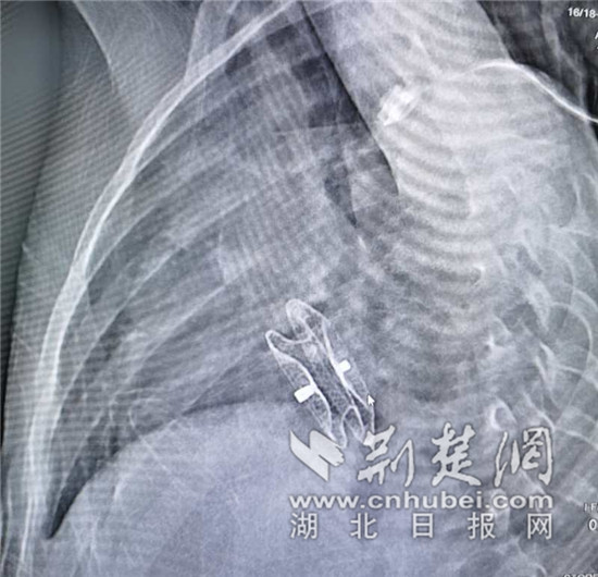 |1岁7个月女娃体重如半岁婴儿 专家心内“撑伞”为低体重儿堵“大洞”