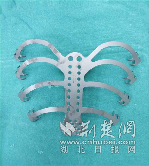 |罹患肿瘤后肋骨切除 专家助其重建“钢筋铁骨”新胸廓