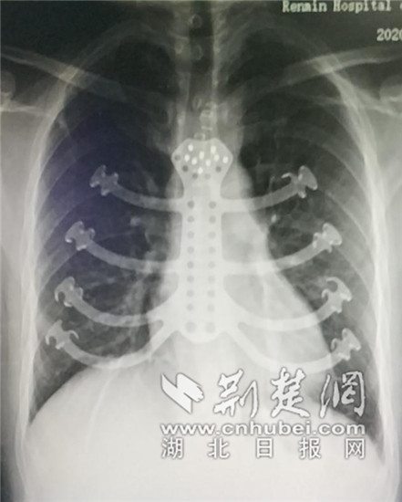|罹患肿瘤后肋骨切除 专家助其重建“钢筋铁骨”新胸廓