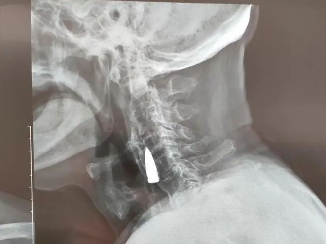 95歲老兵到醫院拍片，發現頸部有子彈頭！