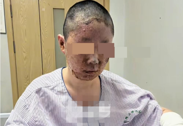 27歲美妝博主自述被家中液化氣泄漏燒傷后毀容