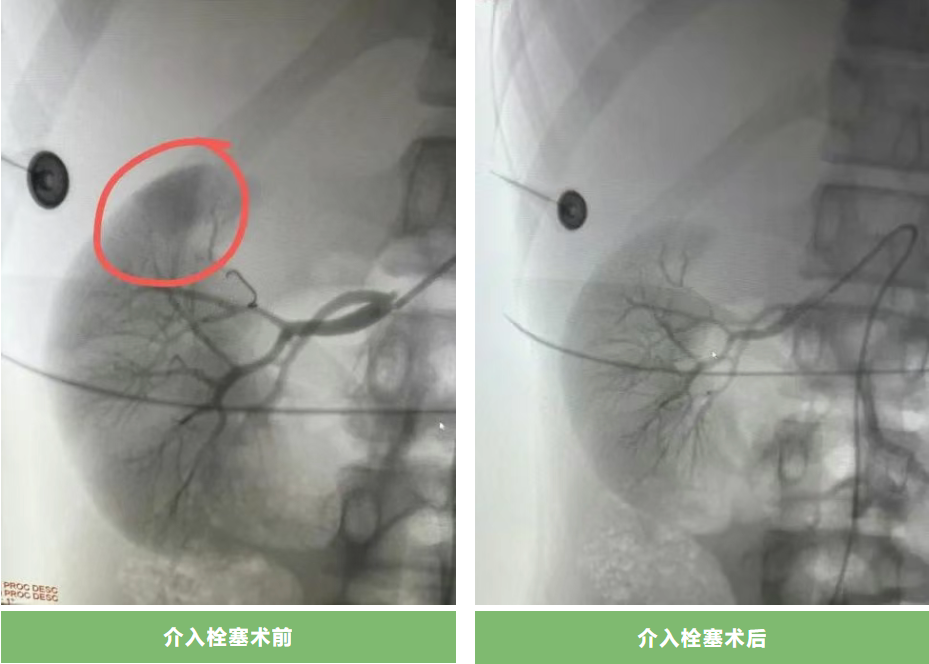 潜江中心医院：15岁少年高处坠落肾破裂，微创介入保肾救命！