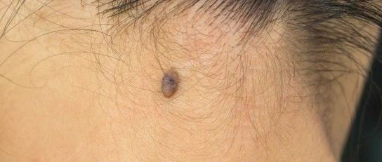 這幾個(gè)地方長(zhǎng)“痣”，可能會(huì)癌變！醫(yī)生緊急提醒