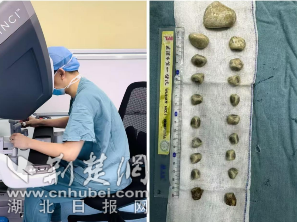 许多大！ 19块石头填充了正确的肾脏，机器人手