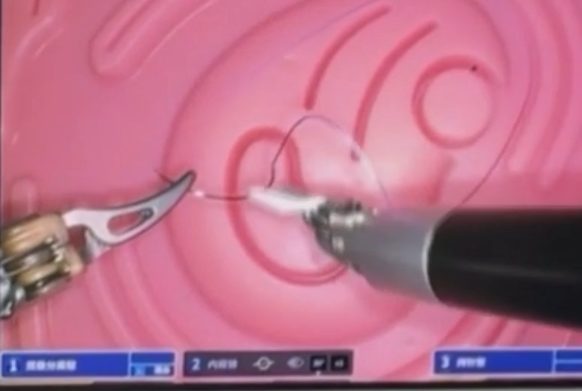 算力开挂！ AI辅助医生在伦敦为北京患者做手术