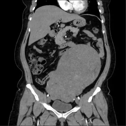 潜江市中心医院完整切除罕见巨大子宫