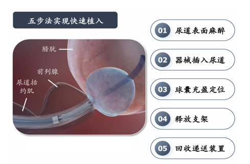 15分钟打通生命通道！荆州一医“一个支架”解“男”题