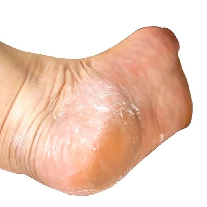 脚后跟总开裂起皮？小心这几种疾病