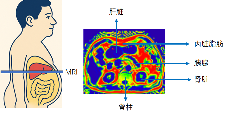  科学减脂！MRI全身脂肪定量帮您“看得见，减得准”