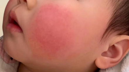 春季“红脸蛋”高发！医生教你分型急救