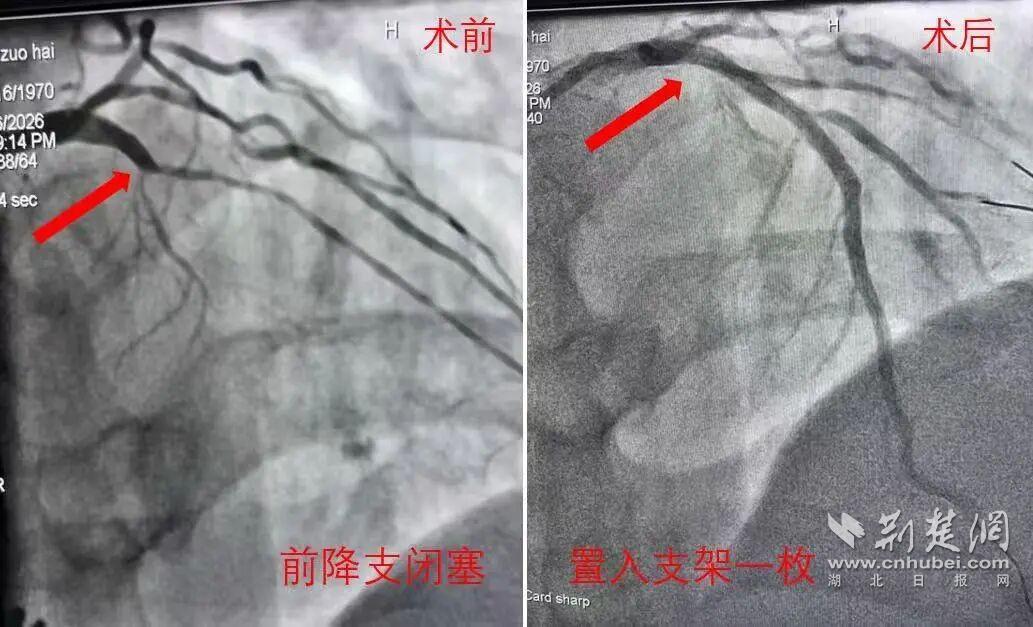 49分钟开通生命通道：仙桃市中医医院急性心梗救治再创佳绩