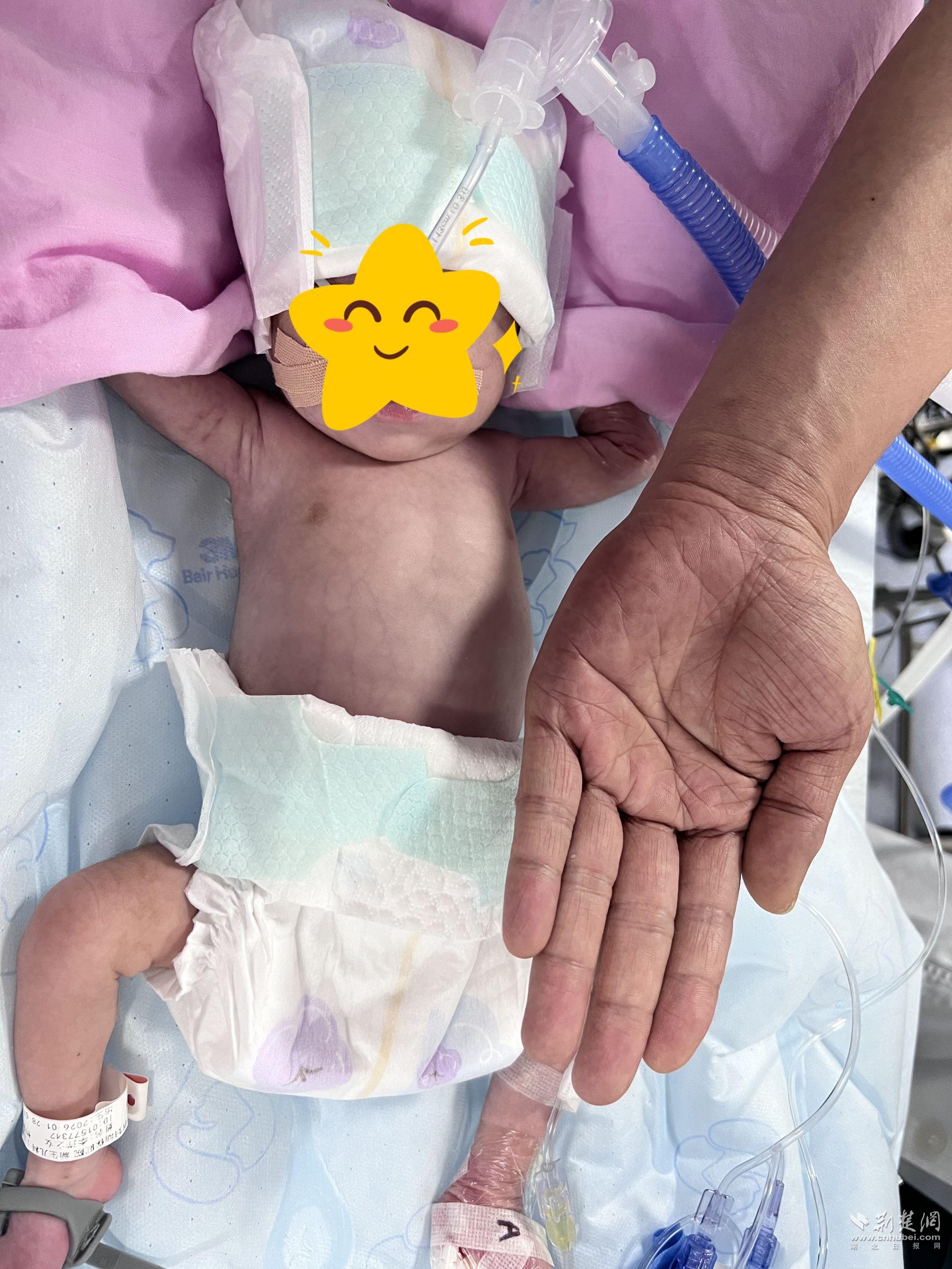  27周“掌心宝宝”成功“补心”  湖北省妇幼保健院刷新全省超低体重先心病介入治疗纪录