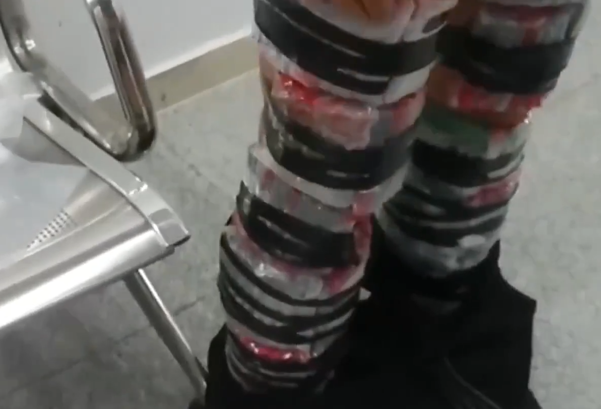 男子腿上绑满减肥针入境