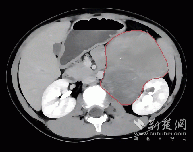 体操游泳样样棒，“健康娃”却查出大肿瘤！医生提醒重视这项体检