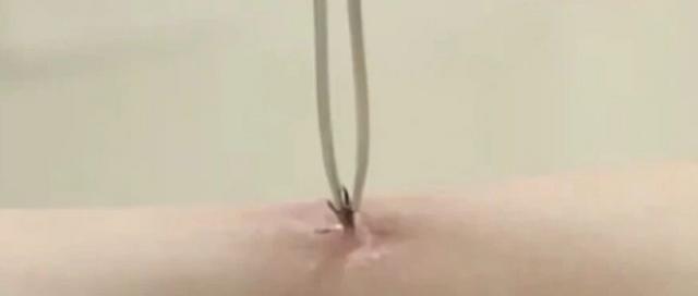 高烧不退，医生从患者身上拔出17只蜱虫……（附防虫攻略）
