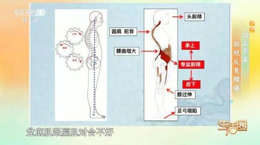 总是腰酸、腰痛？可能是骨盆前倾的信号，一招自测