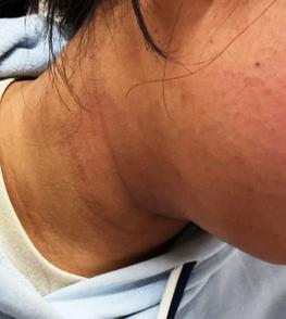 每天一杯奶茶，孩子脖子越来越黑？是身体在报警